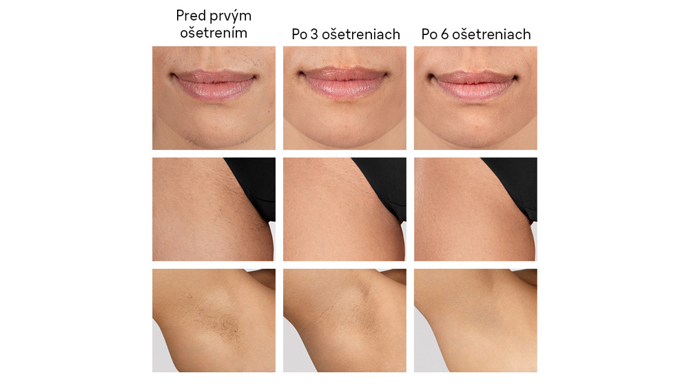 Porovnanie výsledkov po použití IPL Braun IPL5351 Silk·expert
