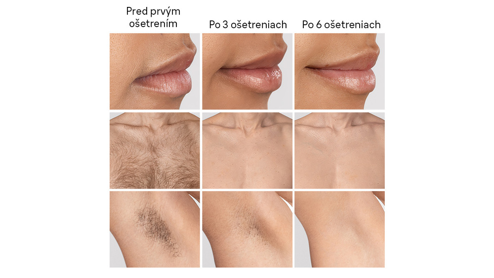 Epilátor Braun Skin i·expert IPL7431 biely/bronzový Porovnanie výsledkov po použití IPL Braun IPL7431 Skin i·expert