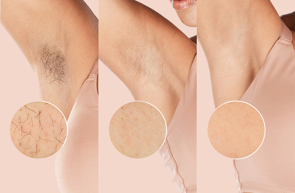 Epilátor Philips Lumea IPL 8000 BRI947/00