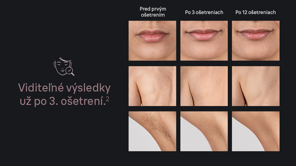 Epilátor Braun Silk-expert Mini IPL1100 ružový Porovnanie výsledkov po použití IPL Braun IPL1111 Silk·expert Mini